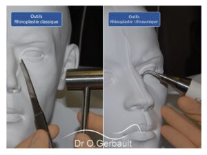 Tout savoir sur la rhinoplastie ultrasonique et ses risques