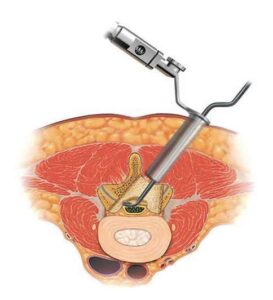 La chirurgie mini-invasive : risqué ou pas ?