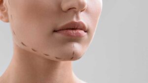 Chirurgie esthétique du menton : risques et effets secondaires