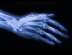 Des chercheurs identifient un nouveau traitement pour l'arthrose
