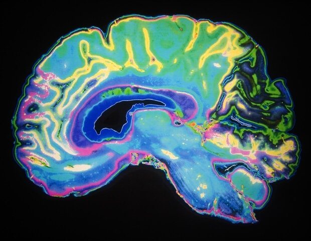picture20162f32fartificially_colored_mri_scan_of_human_brain-daisy_daisy_a8c5d8bbbf824bc8932308e30187510f-620x480-4739201