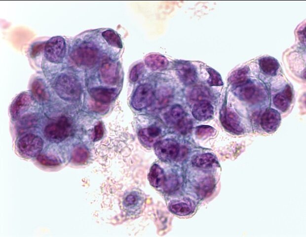 picture20182f72fmalignant_fluid_cytology3b_malignant_cells_of_adenocarcinoma_may_spread_to_fluid__-_david_litman_m1_32ff074a59024fa8aa4ee1b098c2d57a-620x480-5205202