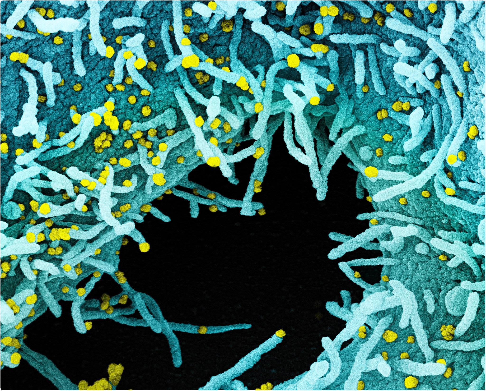 Micrographie électronique à balayage colorisée d'une cellule fortement infectée par des particules virales du SRAS-CoV-2 (jaune), isolée à partir d'un échantillon de patient. La zone noire de l'image est un espace extracellulaire entre les cellules. Image prise au centre de recherche intégré (IRF) du NIAID à Fort Detrick, Maryland. Crédit: NIAID