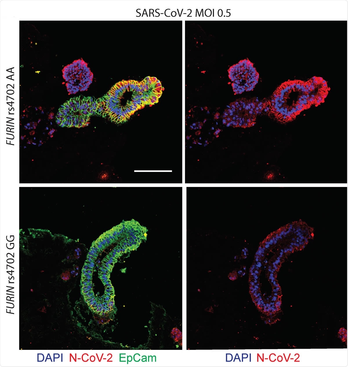 La conversion allélique à FURIN rs4702 dans les alvéolosphères et les neurones a un impact sur l'infection par le SRAS-CoV-2. Coloration par immunofluorescence représentative contre la protéine nucléocapside (N) du SARS-CoV-2 (rouge), le marqueur épithélial EPCAM (vert) et DAPI (bleu). Des alvéolosphères ont été générées à partir de lignées C2 FURIN rs4702 AA et GG et infectées avec un simulacre ou une MOI de 0,5 SARS-CoV-2 pendant 24 heures. Barre d'échelle: 100 μm.