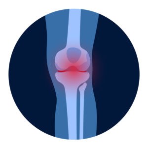 Arthrite dans l'articulation du genou