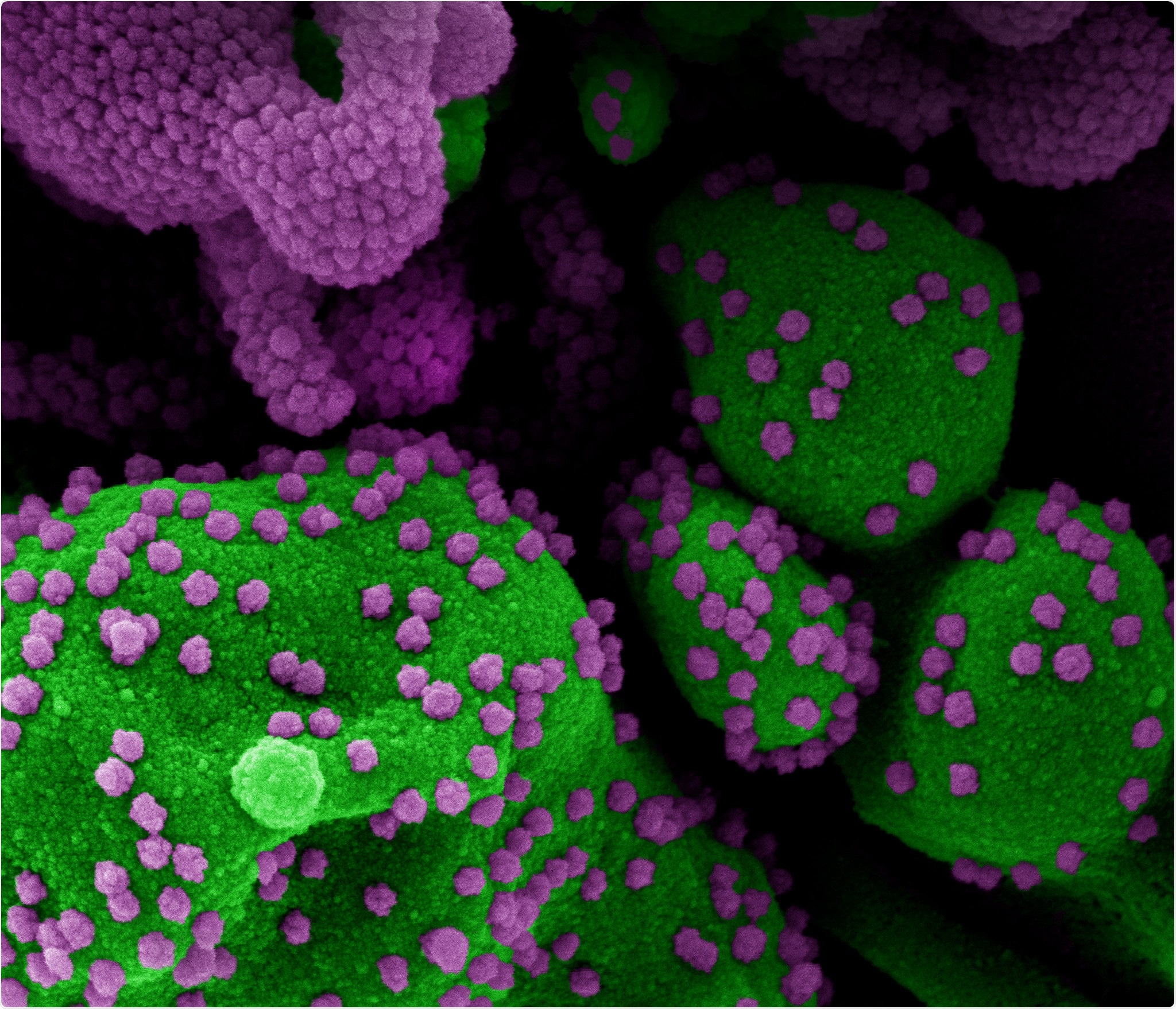 Micrographie électronique à balayage colorisée d'une cellule apoptotique (verte) fortement infectée par des particules de virus SRAS-CoV-2 (violet), isolée à partir d'un échantillon de patient. Image au centre de recherche intégré (IRF) du NIAID à Fort Detrick, Maryland. Crédit: NIAID