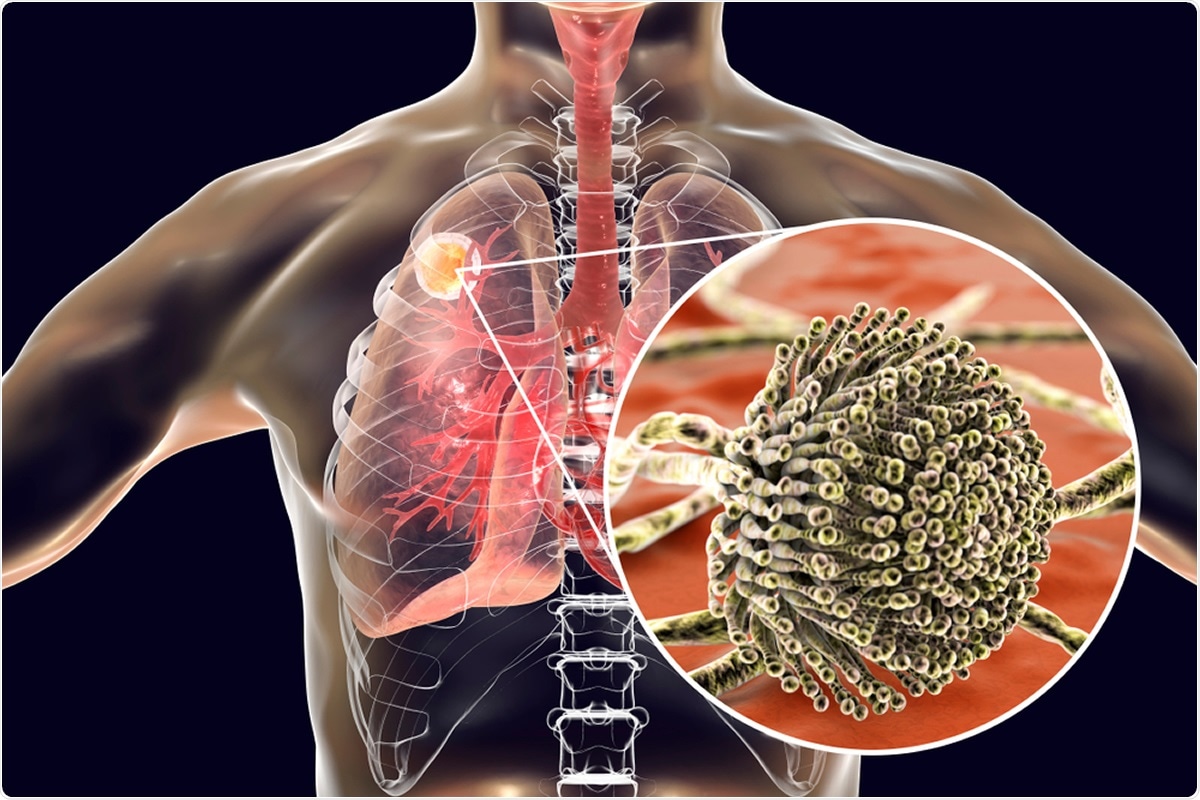Étude: Analyse génomique et phénotypique d'isolats d'aspergillose pulmonaire associée au COVID-19 d'Aspergillus fumigatus.  Crédit d'image Kateryna Kon / Shutterstock