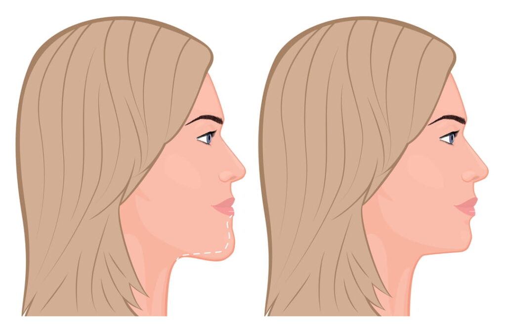 Génioplastie : les risques de la chirurgie esthétique du menton
