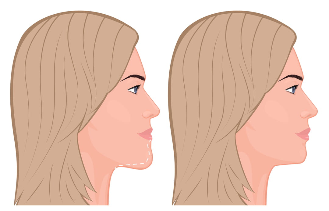 Génioplastie : les risques de la chirurgie esthétique du menton