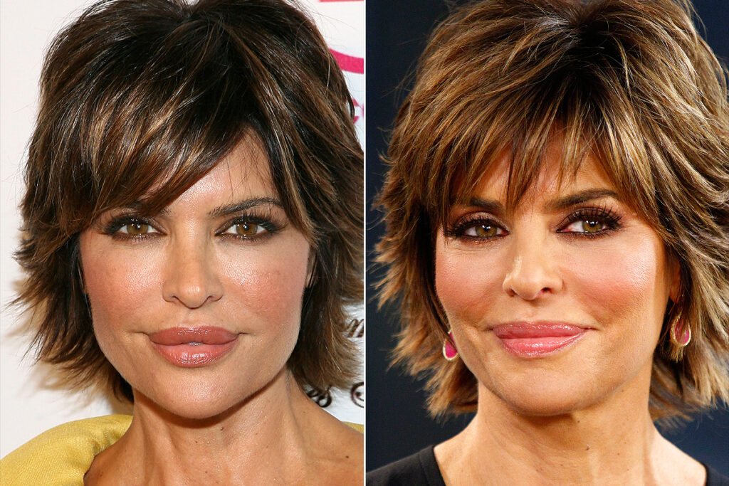 Lisa Rinna et le botox