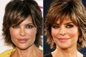 Lisa Rinna et le botox