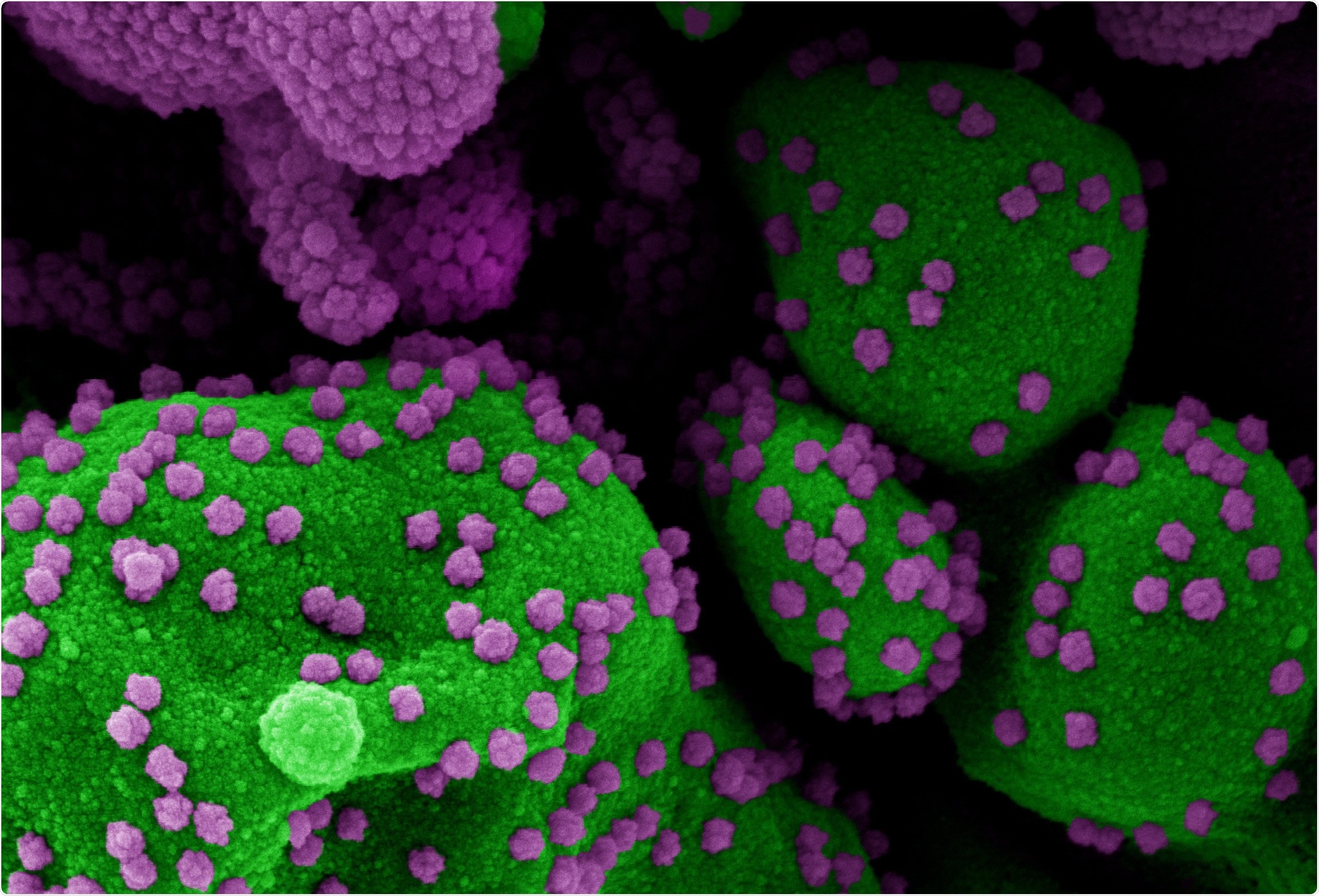 Étude: Les variantes de sensibilité au COVID-19 s'associent aux caillots sanguins, à la thrombophlébite et aux maladies circulatoires.  Crédit d'image: NIAID