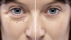 Blépharoplastie : les risques de la chirurgie des cernes