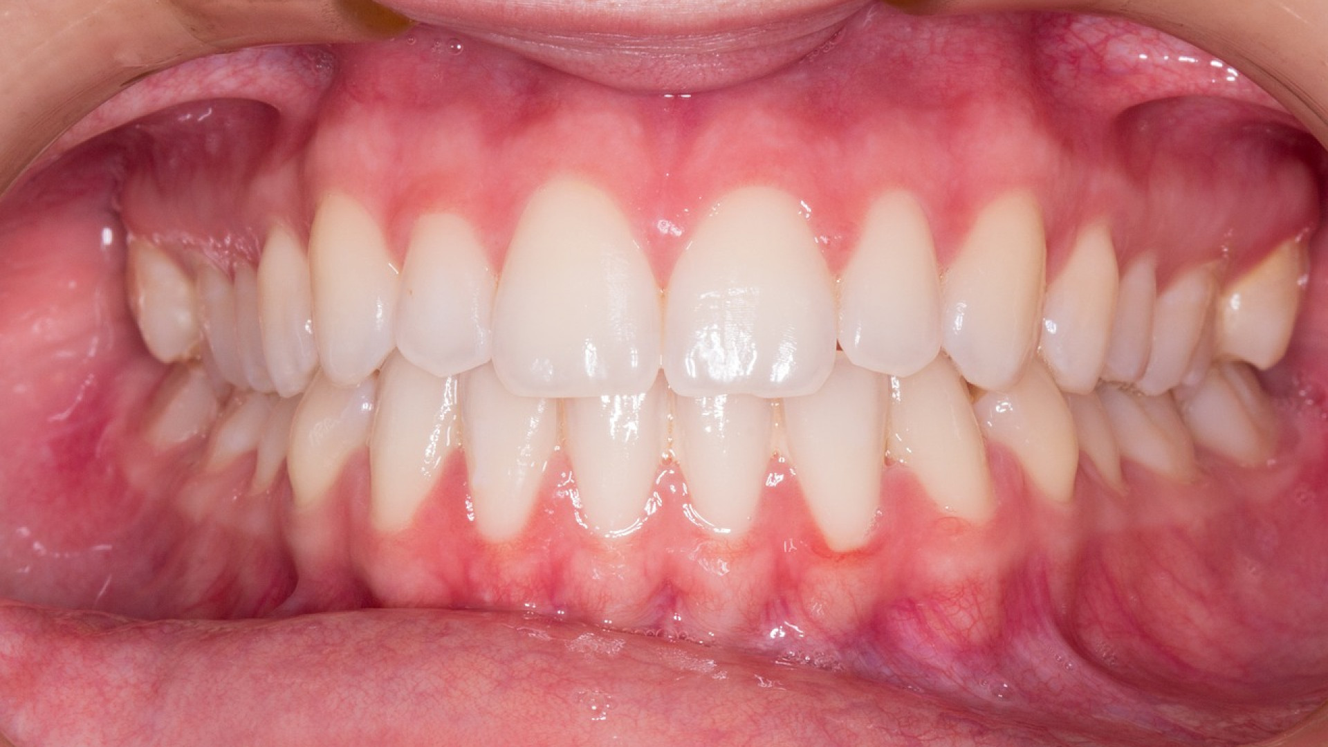 Quels sont les avantages d'une brosse à dents ultrasonique ?