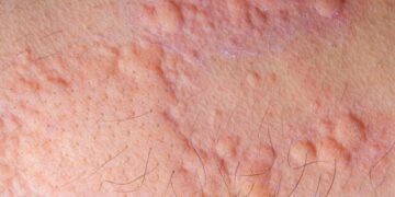 La recherche révèle des différences clés entre l'urticaire chronique spontanée chez l'enfant et l'adulte