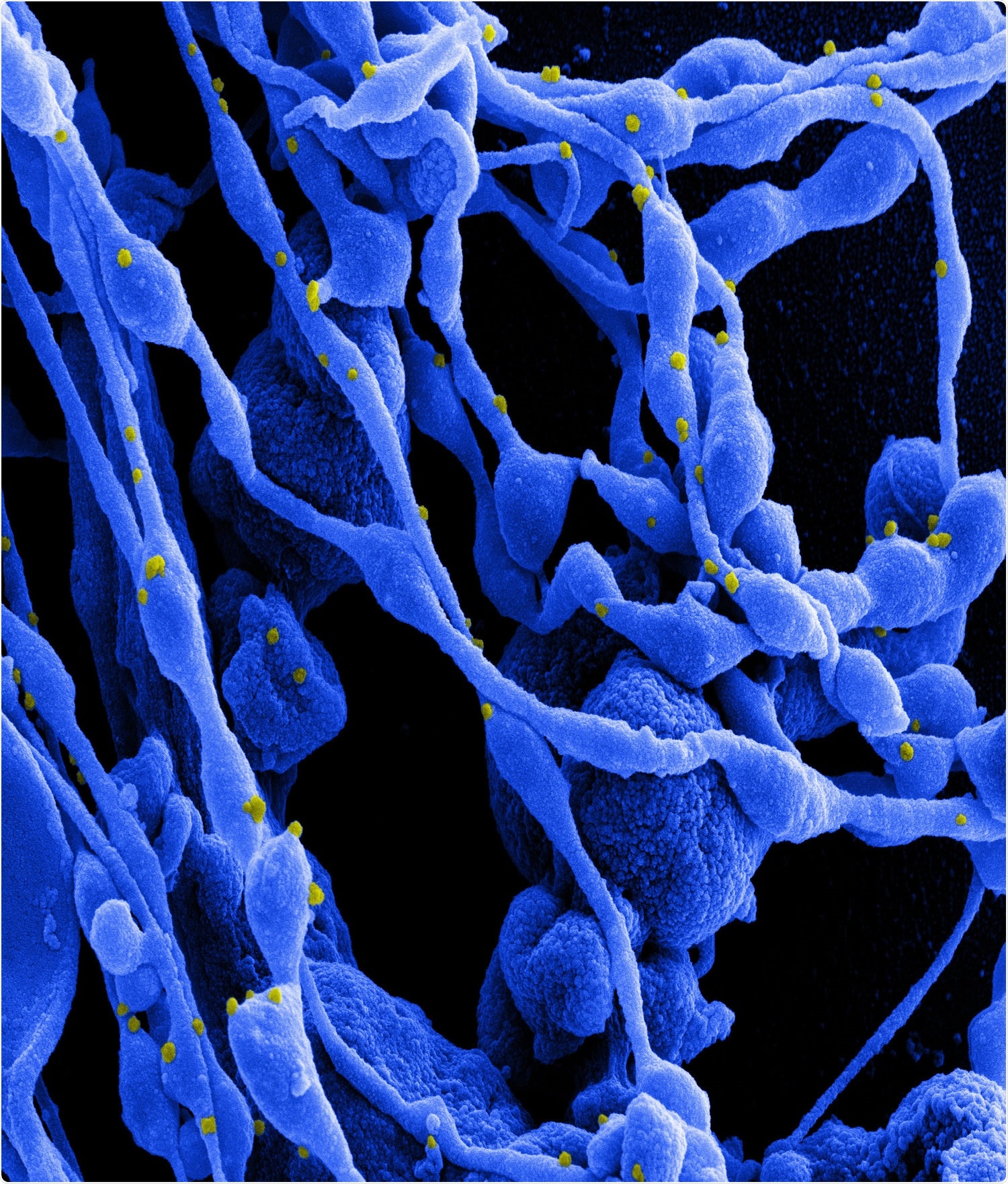 Study: SARS-CoV-2 spike-specific memory B cells express markers of durable immunity after non-severe COVID-19 but not after severe disease. Image Credit: NIAID