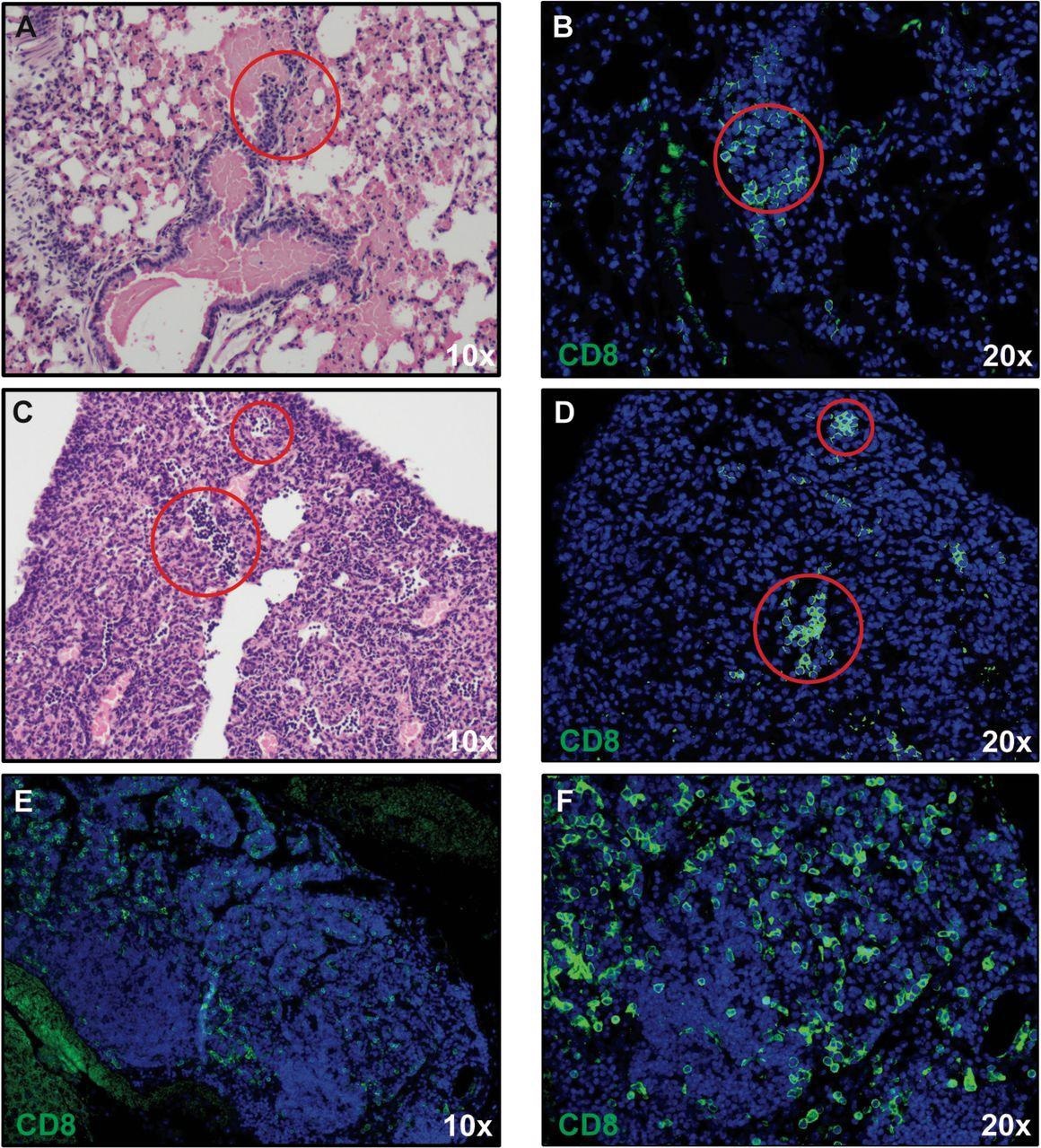 Infiltration de lymphocytes T CD8+ dans les poumons de souris infectées par le SRAS-CoV-2.  La coloration H&E des poumons de souris infectées par le SRAS-CoV-2 au jour 7 après l'infection révèle une inflammation (A et C) associée à une infiltration de lymphocytes T CD8+ (B et D) telle que déterminée par coloration immunofluorescente.  Des structures semblables à des ganglions lymphatiques ont également été détectées contenant des cellules T CD8+ (E et F).  Panneaux A, C et E grossissement 10X ;  panneaux B, D et F grossissement 20X.