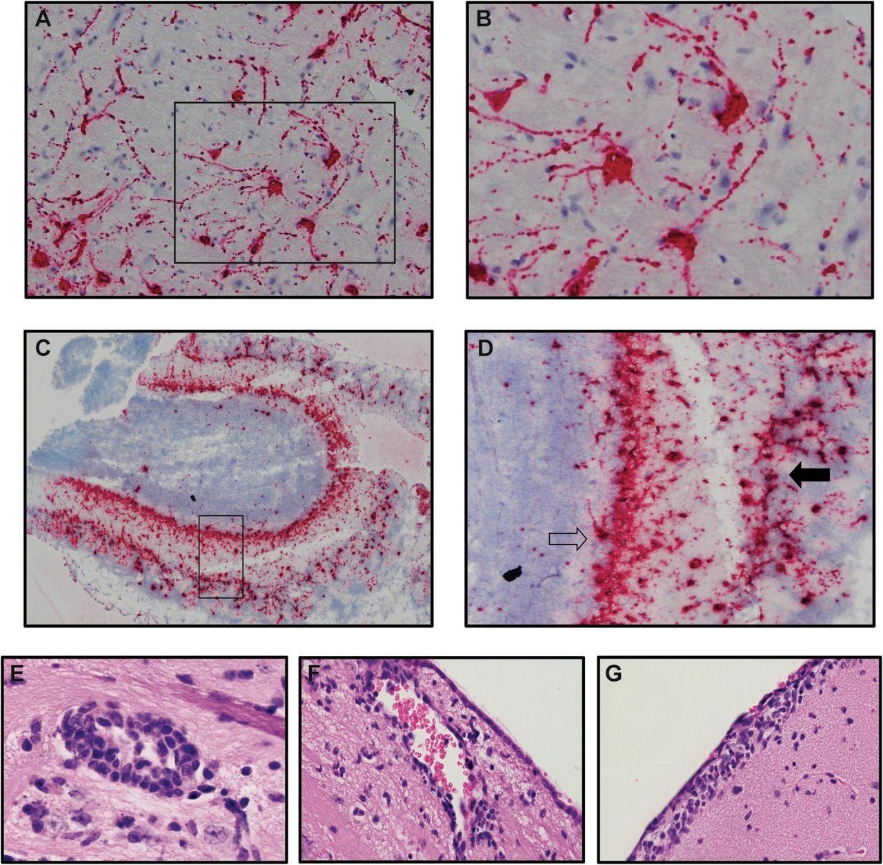 Les neurones sont des cibles d'infection dans le cerveau des souris K18-hACE2 infectées par le SRAS-CoV-2.  Les cerveaux de souris infectées par le SRAS-CoV-2 au jour 7 pi ont été analysés pour évaluer les cibles cellulaires de l'infection par hybridation in situ à l'aide de l'hybridation in situ RNAscope à l'aide de sondes spécifiques à Spike.  (A) Les cellules dans le cortex avec la morphologie des neurones étaient les principales cibles de l'infection ;  (B) image à haute puissance de cellules encadrées dans le panneau A montre l'ARN viral présent dans le corps cellulaire ainsi que s'étendant vers le bas des dendrites s'étendant du corps cellulaire.  (C) L'ARN viral a également été détecté dans les bulbes olfactifs au jour 7 pi (D) des cellules d'image haute puissance encadrées dans le panneau C révèlent que les neurones du mitral (flèche ouverte) et du glomérulaire (flèche fermée) sont infectés par le virus.  Images H&E représentatives du cerveau de souris K18-hACE2 infectées au jour 7 pi représentant (E) un brassard périvasculaire, (F) une inflammation sous-ventriculaire et (G) une leptoméningite.