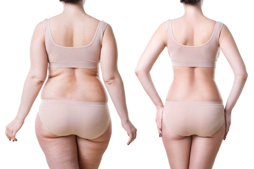 Liposuccion : un traitement de référence pour une silhouette au top