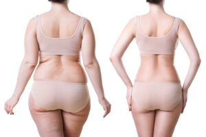 Liposuccion : un traitement de référence pour une silhouette au top