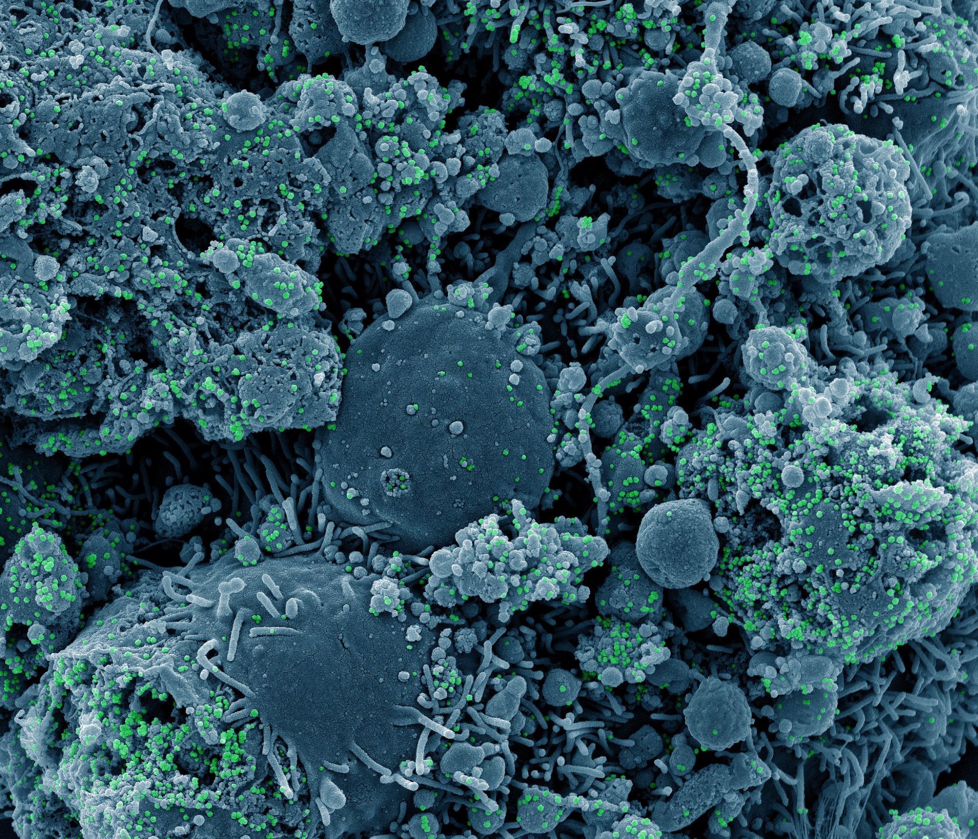 COVID isolation and quarantine period for general population shortened by CDC