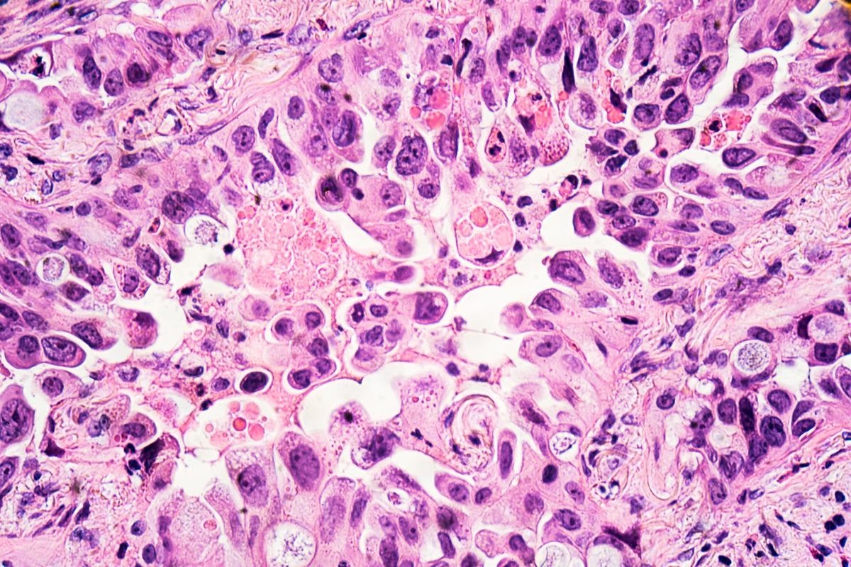 Study: The effect of COVID-19 mRNA vaccine on respiratory system: human lung carcinoma cells by means of Raman spectroscopy and imaging. Image Credit: David A Litman/Shutterstock