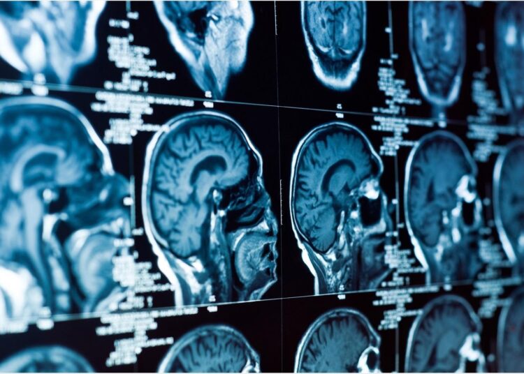 Study: Hospitalisation for COVID-19 predicts long-lasting cerebrovascular impairment: A prospective observational cohort study​​​​​​​. Image Credit: SvedOliver / Shutterstock