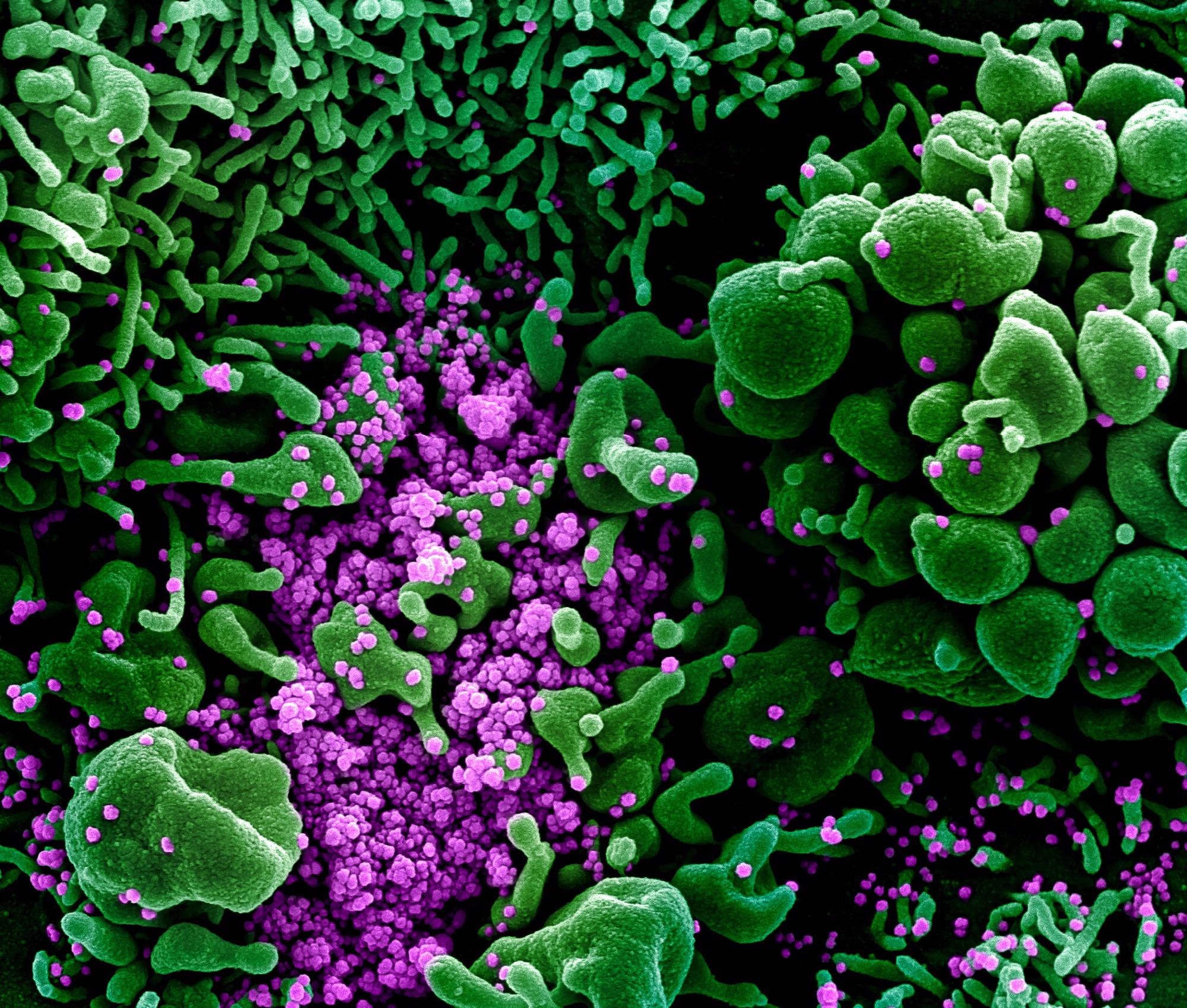 Study: Soluble P2X7 receptor is elevated in the plasma of COVID-19 patients and correlates with disease severity. Image Credit: NIAID