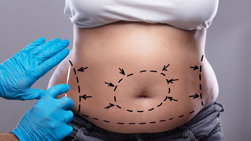 Chirurgie du ventre