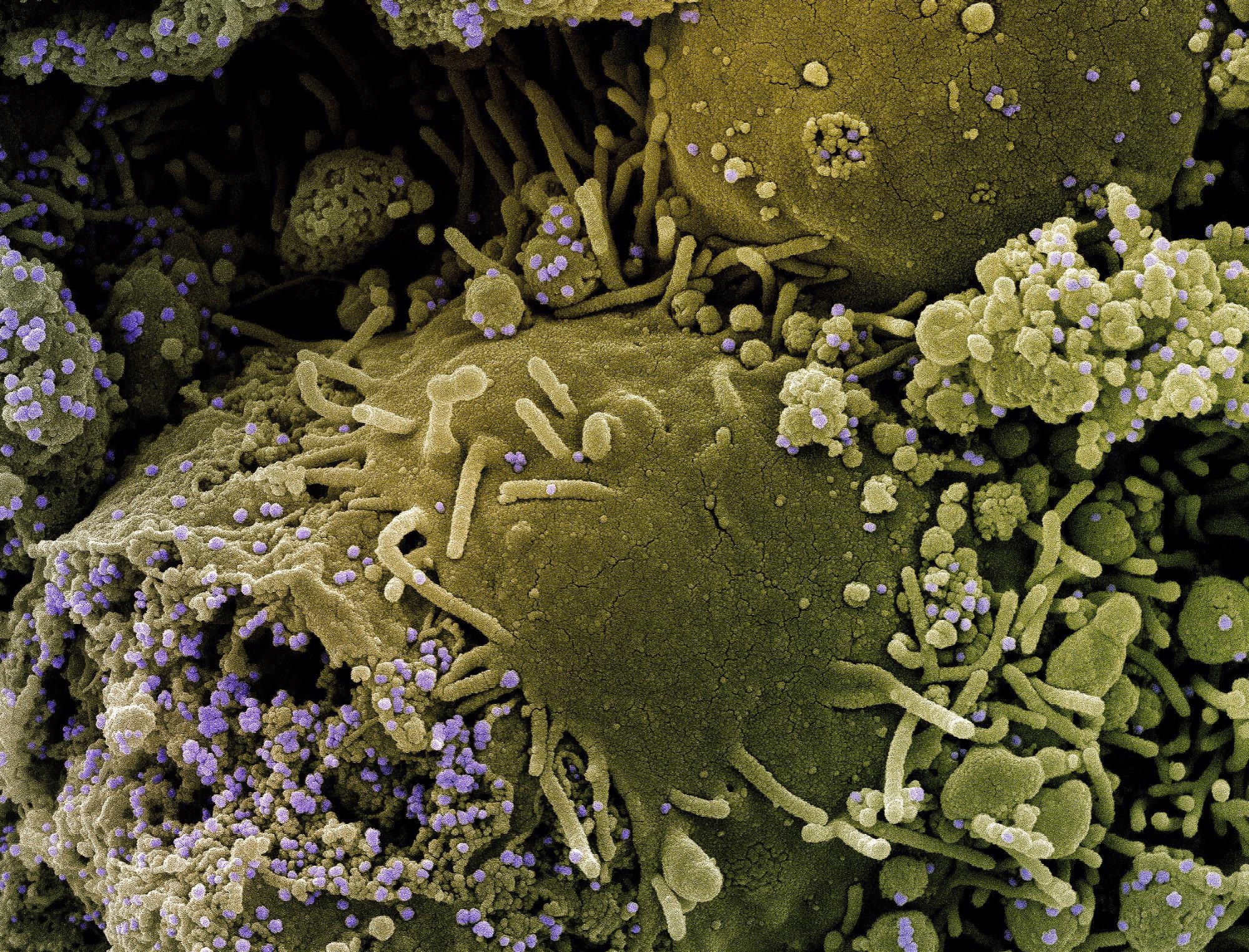 Study: Abnormal global alternative RNA splicing in COVID-19 patients. Image Credit: NIAID