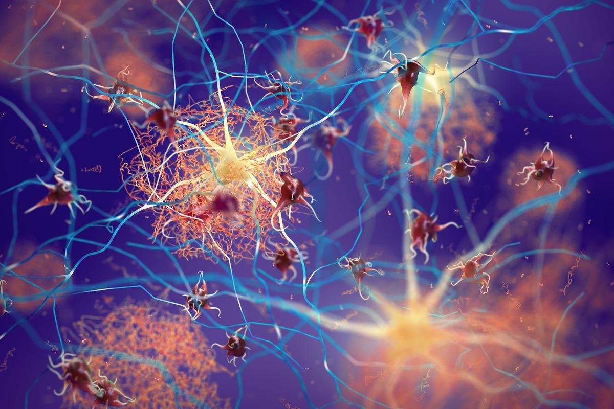 Study: Sex-Driven Differences in the Effectiveness of Individualized Clinical Management of Alzheimer’s Disease Risk. Image Credit: nobeastsofierce/Shutterstock