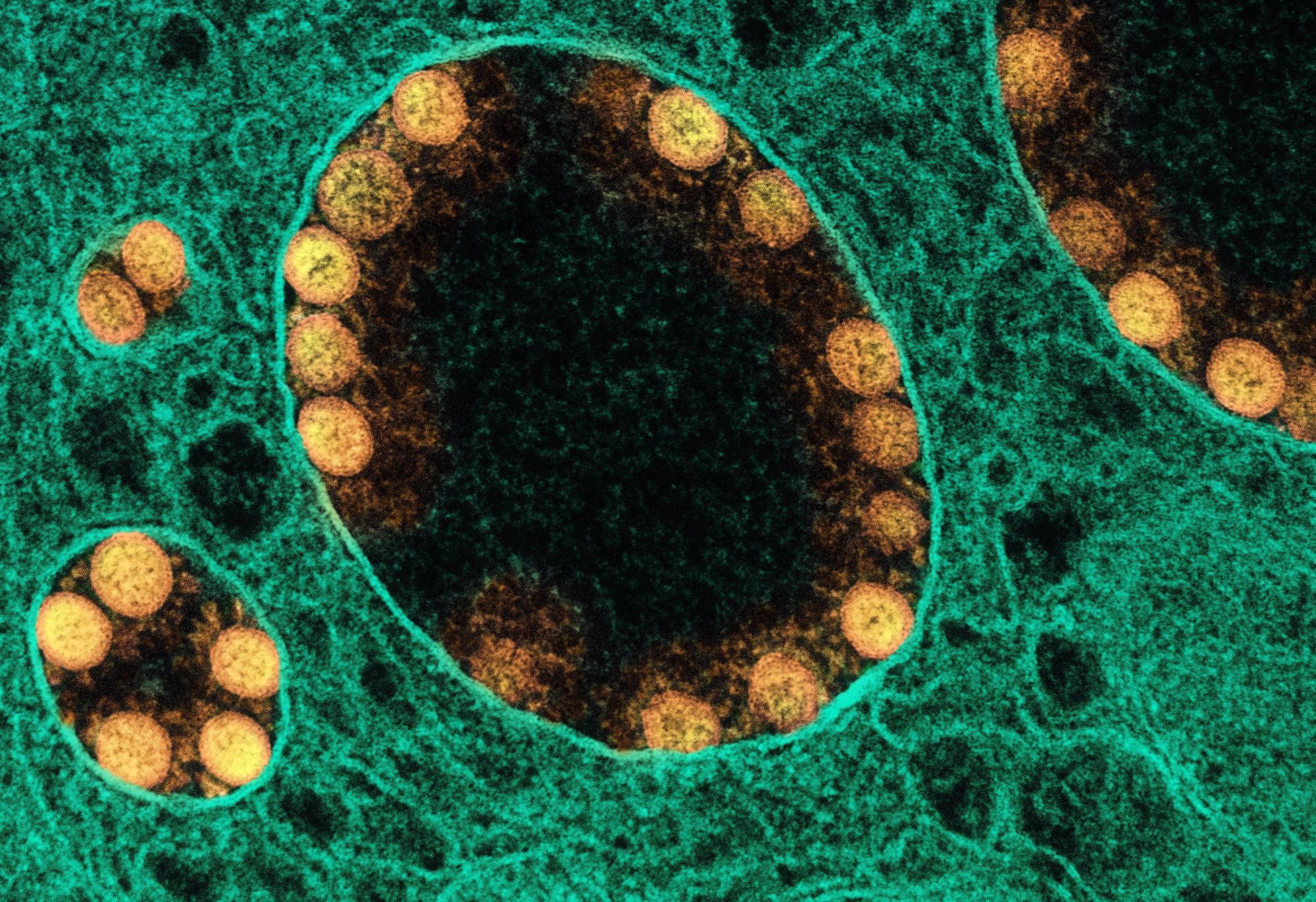 Study: Estimates of excess mortality for the five Nordic countries during the Covid-19 pandemic 2020-2021. Image Credit: NIAID