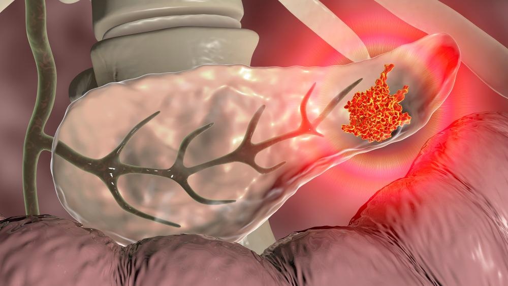 Pancreatic Cancer