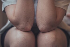 Une méthode de kinésithérapie contre les tendinites du coude