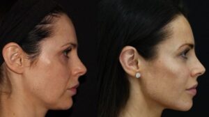 Jawline Contouring