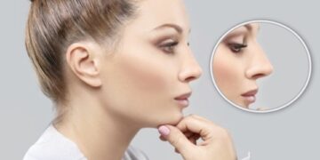 Rhinoplastie ultrasonique à Marseille