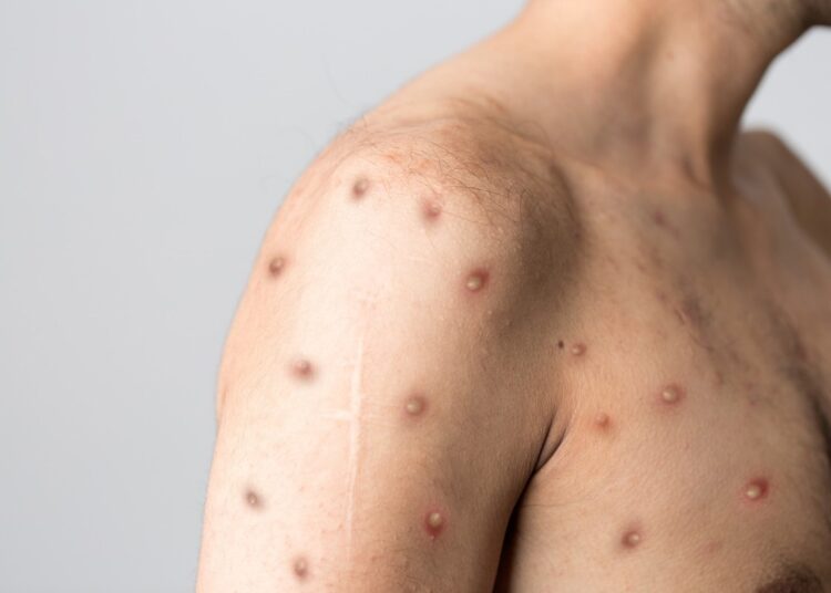 Study: Monkeypox virus: a re-emergent threat to humans. Image Credit: Berkay Ataseven/Shutterstock