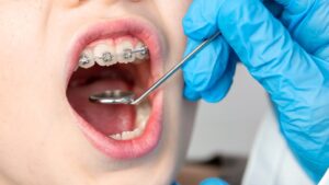 Tout savoir sur l’alignement dentaire