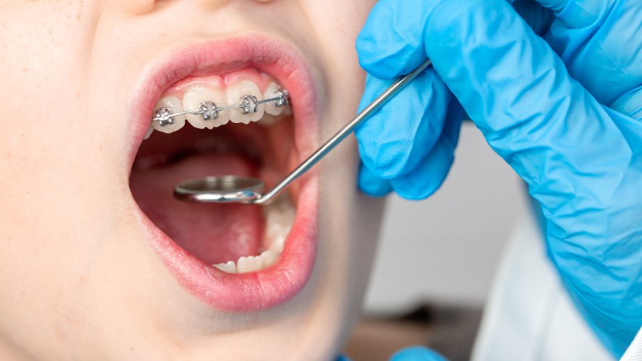 Tout savoir sur l’alignement dentaire