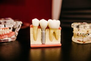 Dentisterie esthétique : 6 raisons justifiant l’usage de la céramique