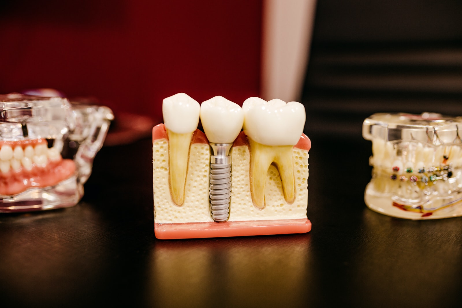 Dentisterie esthétique : 6 raisons justifiant l’usage de la céramique