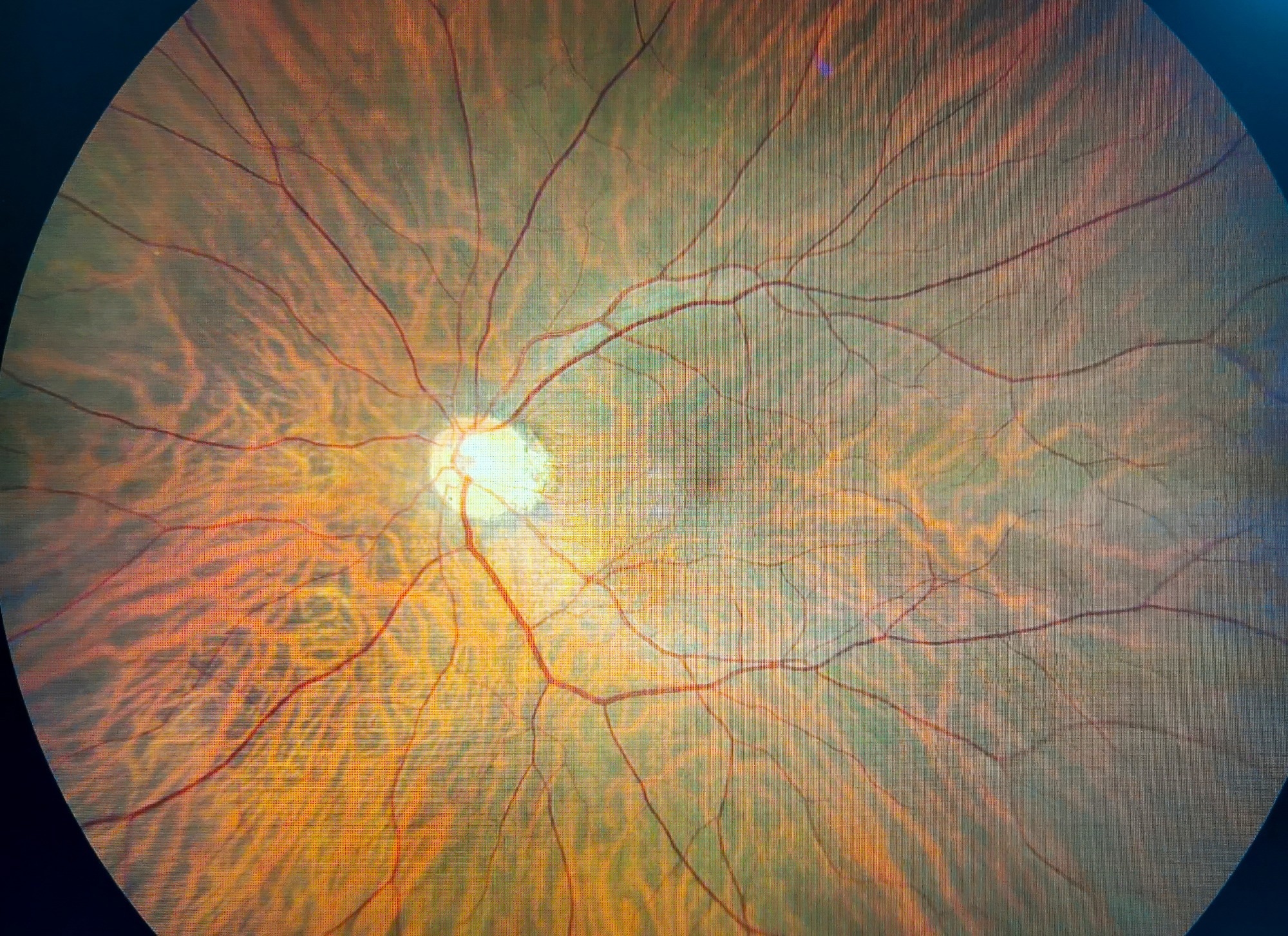 Study: Lutein nanodisks protect human retinal pigment epithelial cells from UV light-induced damage. Image Credit: Monet_3k/Shutterstock