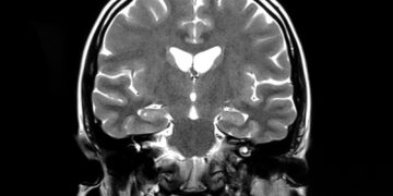 Study: Brain microstructural changes and fatigue after COVID-19. Image Credit: flowersandtraveling / Shutterstock.com