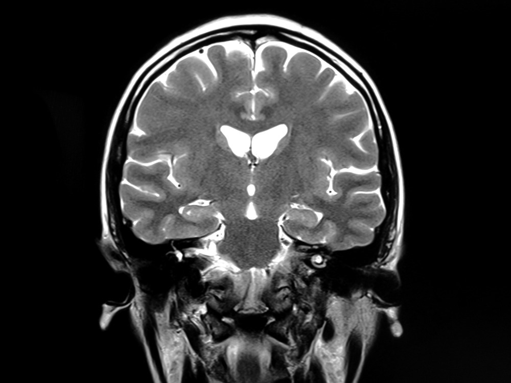 Study: Brain microstructural changes and fatigue after COVID-19. Image Credit: flowersandtraveling / Shutterstock.com