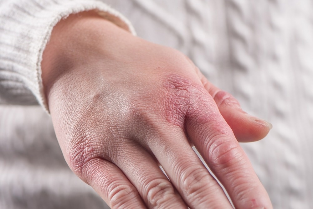 Study: COVID-19 pandemic associated chilblains. More link for SARS-CoV-2 and less evidence for high interferon type-1 systemic response. Image Credit: kungfu01/Shutterstock
