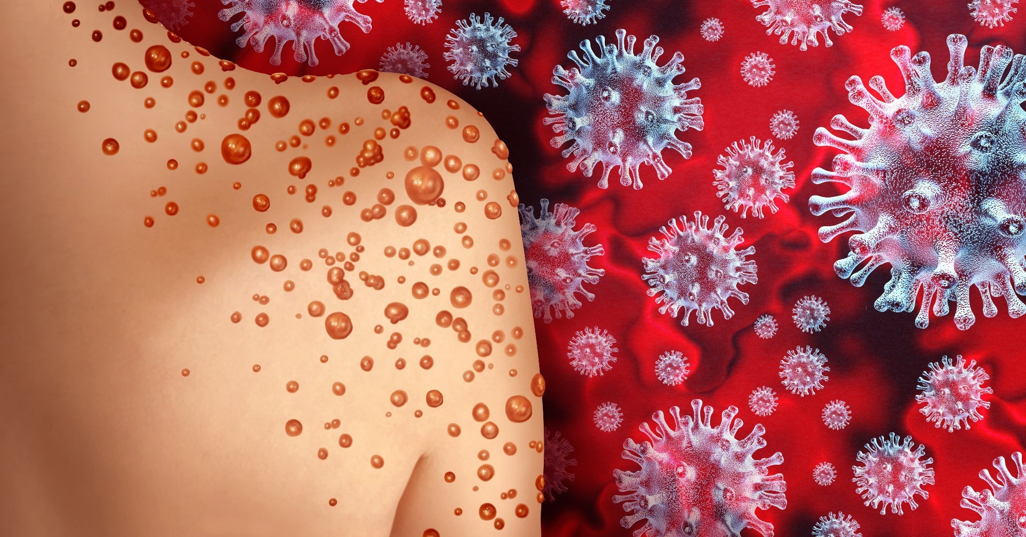 Study: Human Monkeypox: A Comprehensive Narrative Review and Analysis of the Public Health Implications. Image Credit: Lightspring/Shutterstock