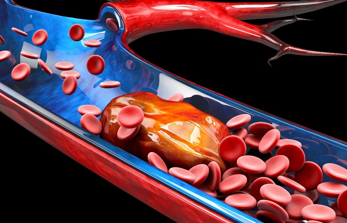 Study: Association of COVID-19 vs Influenza With Risk of Arterial and Venous Thrombotic Events Among Hospitalized Patients. Image Credit: Victor Josan/Shutterstock