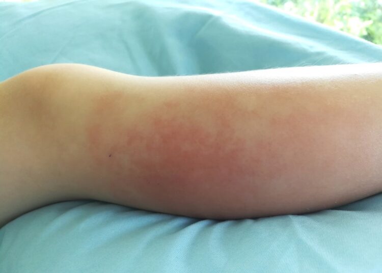 Study: Monkeypox infection and bacterial cellulitis: a complication to look for. Image Credit: DonyaHHI/Shutterstock