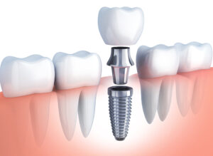Comprendre les contours d’une pose d’implants dentaires