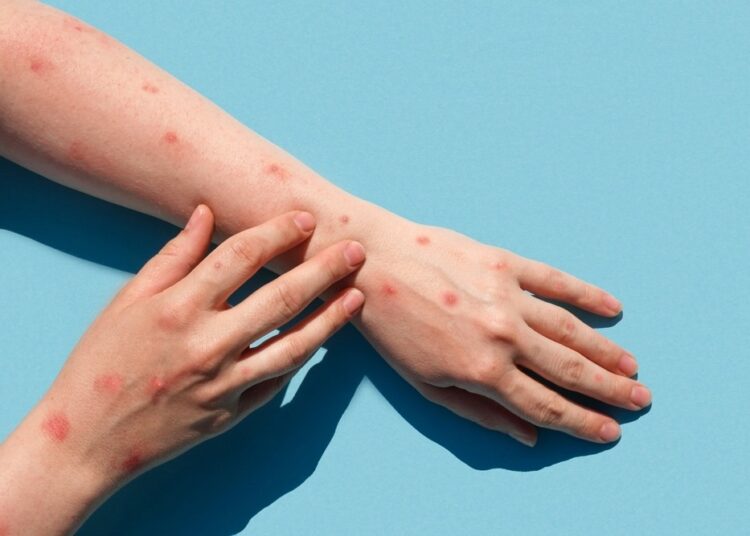 Study: Orthopoxvirus Testing Challenges for Persons in Populations at Low Risk or Without Known Epidemiologic Link to Monkeypox — United States, 2022. Image Credit: Marina Demidiuk/Shutterstock